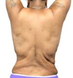 Bodytite: Before & After Photos