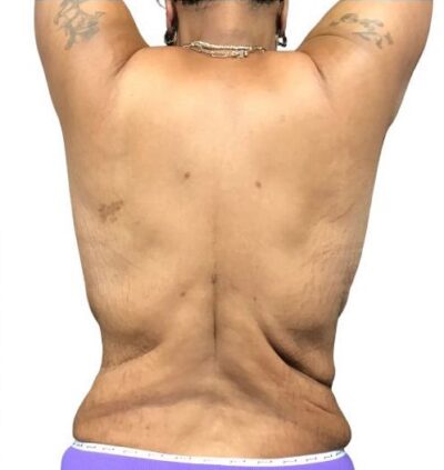 Bodytite: Before & After Photos