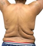 Bodytite: Before & After Photos