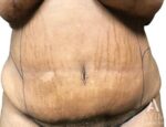 Bodytite: Before & After Photos