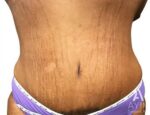 Bodytite: Before & After Photos