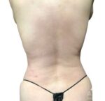 Bodytite: Before & After Photos