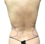 Bodytite: Before & After Photos