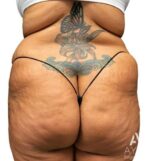 Bodytite: Before & After Photos