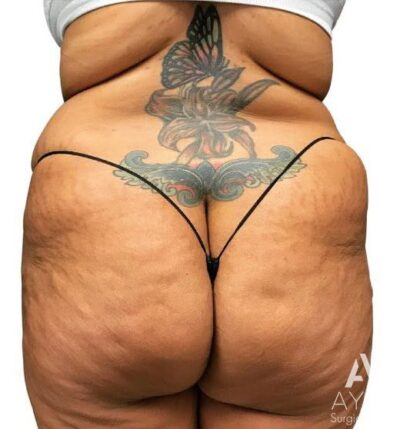 Bodytite: Before & After Photos