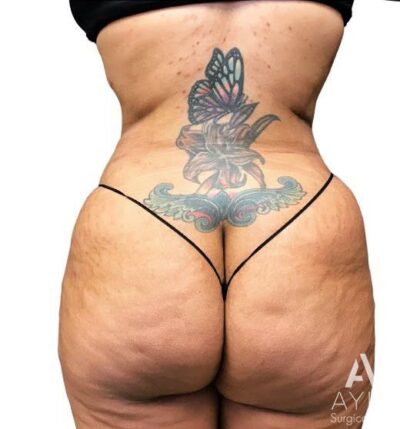 Bodytite: Before & After Photos