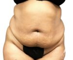 Bodytite: Before & After Photos