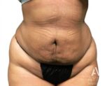 Bodytite: Before & After Photos
