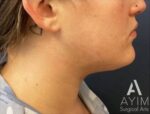 Liposuction: Before & After Photos