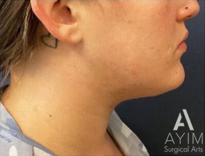 Liposuction: Before & After Photos