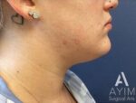 Liposuction: Before & After Photos