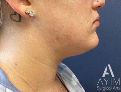 Liposuction: Before & After Photos