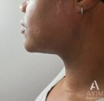 Liposuction: Before & After Photos