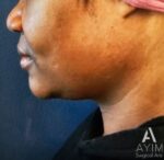 Liposuction: Before & After Photos