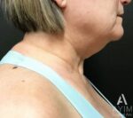 Facetite: Before & After Photos