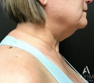 Facetite: Before & After Photos