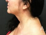 Facetite: Before & After Photos
