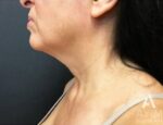 Facetite: Before & After Photos