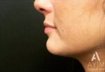 Dermal Filler: Before & After Photos