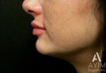 Dermal Filler: Before & After Photos