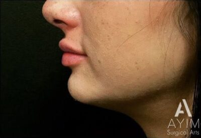 Dermal Filler: Before & After Photos