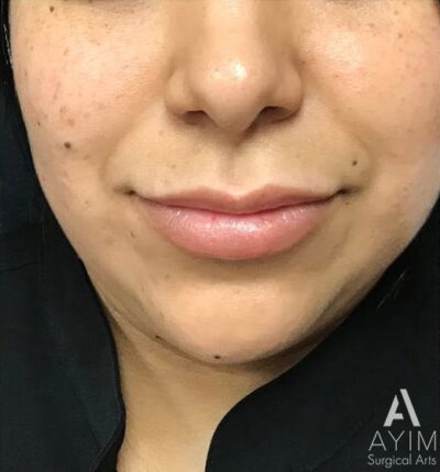 Lip Flip: Before & After Photos