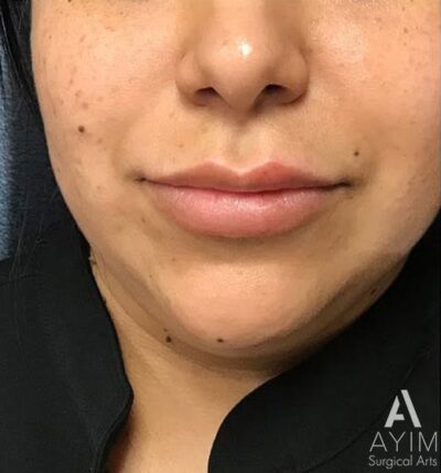 Lip Flip: Before & After Photos