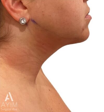 Liposuction: Before & After Photos