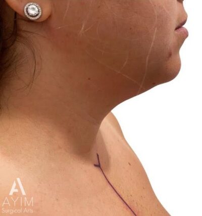 Liposuction: Before & After Photos