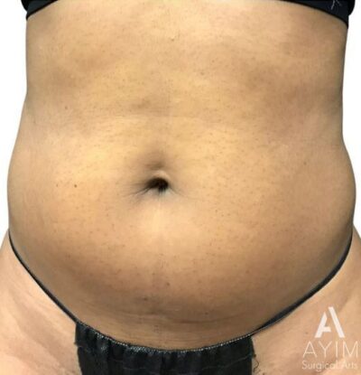 Liposuction: Before & After Photos