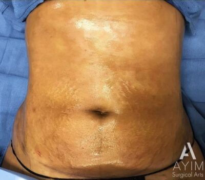 Liposuction: Before & After Photos