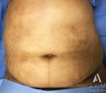 Liposuction: Before & After Photos