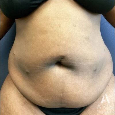 Liposuction: Before & After Photos