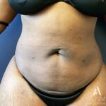 Liposuction: Before & After Photos
