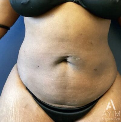 Liposuction: Before & After Photos