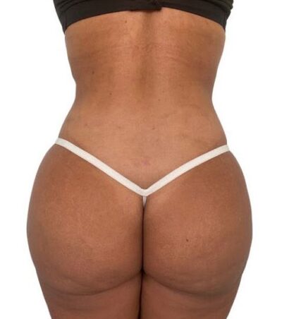 Liposuction: Before & After Photos