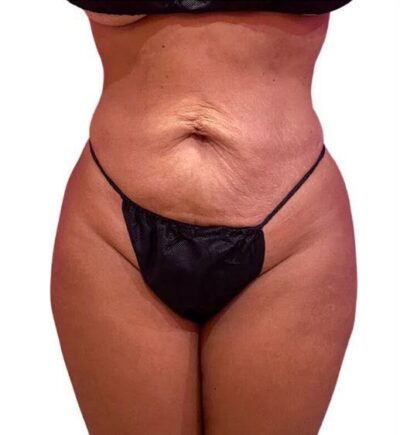 Liposuction: Before & After Photos