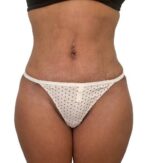 Liposuction: Before & After Photos