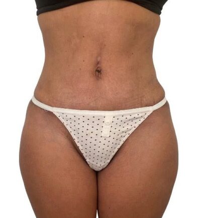 Liposuction: Before & After Photos