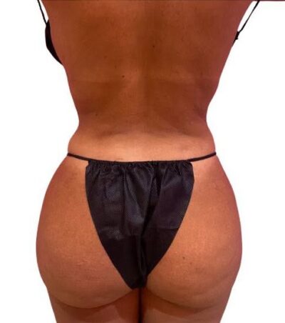 Liposuction: Before & After Photos