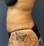 Liposuction: Before & After Photos