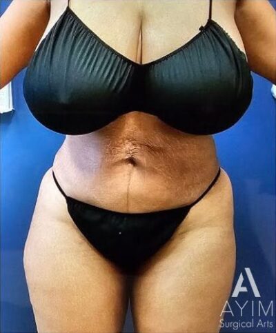 Liposuction: Before & After Photos