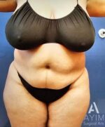 Liposuction: Before & After Photos
