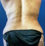 Liposuction: Before & After Photos
