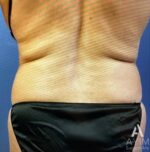 Liposuction: Before & After Photos