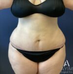 Liposuction: Before & After Photos