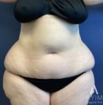 Liposuction: Before & After Photos