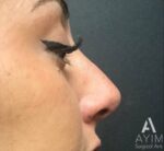 Non-Surgical Rhinoplasty: Before & After Photos