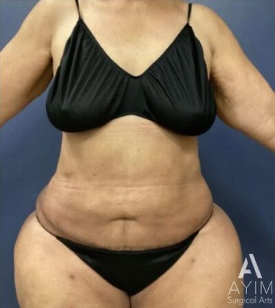 Abdominoplasty: Before & After Photos