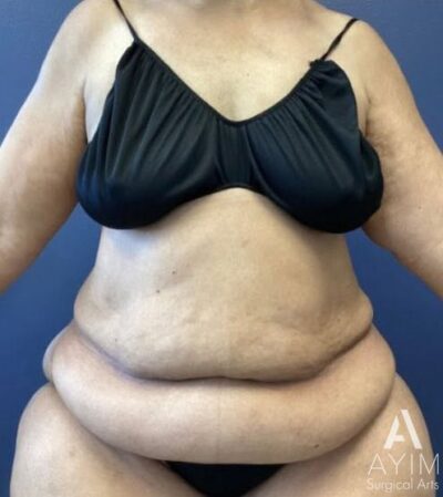 Abdominoplasty: Before & After Photos